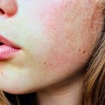 Foods That Cause Acne