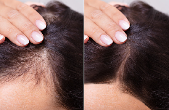 hair loss treatment