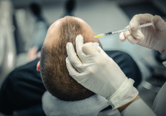 Pros and Cons of Using Minoxidil for Hair Loss Problems