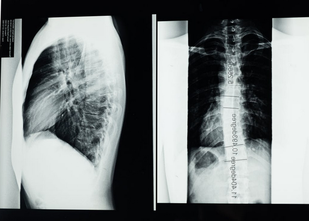 Helpful Tips to Treat Your Child’s Mild Scoliosis